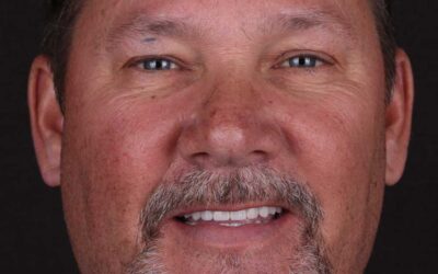 All-on-4 vs. All-on-6 Dental Implants in Chattanooga: Which Full Arch Option Is Right for You?