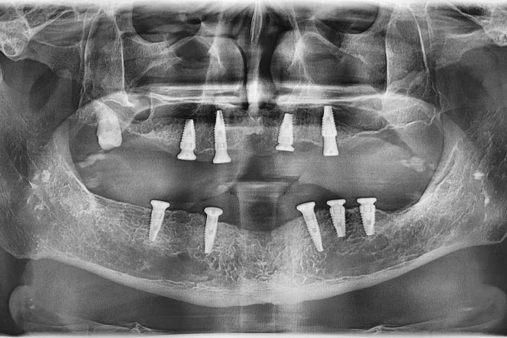 After panoramic X-ray showing multiple implants placed to support full arch All-on dental restorations