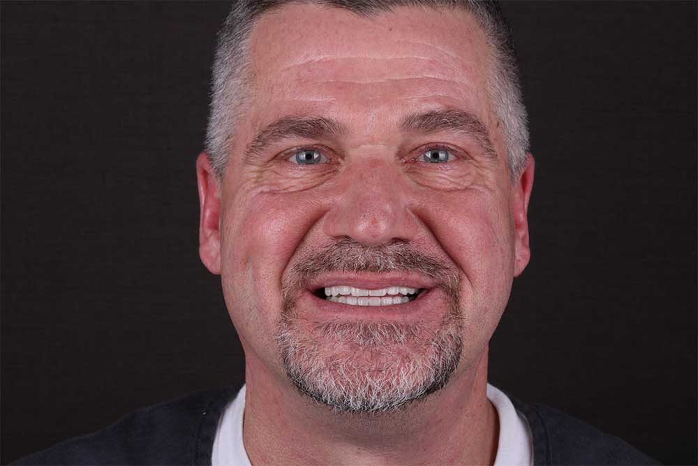 Patient smiling after full mouth restoration with All-on dental implants