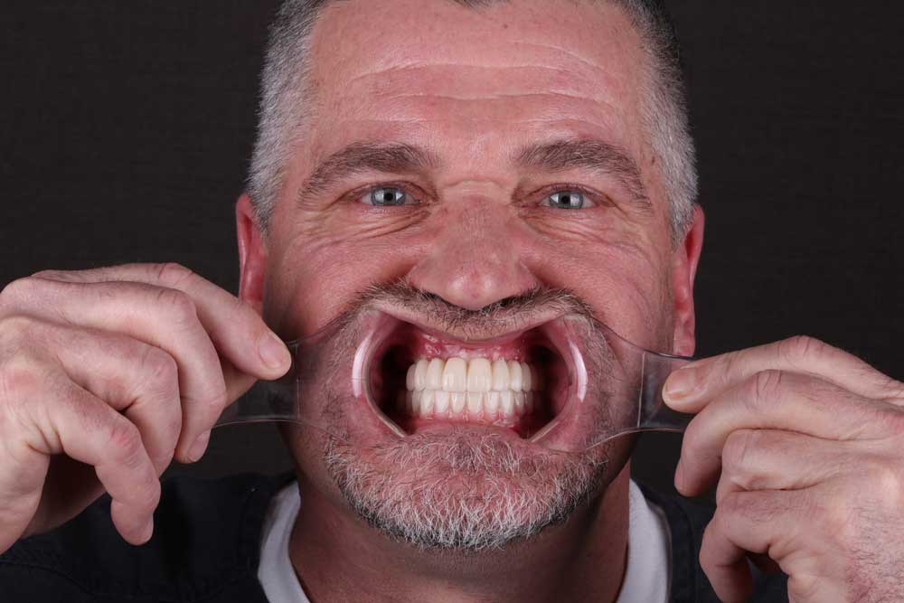 Retracted smile photo showing final full arch implant-supported All-on teeth after treatment