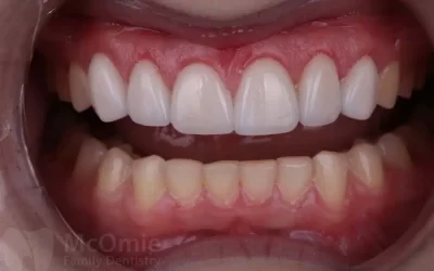 Why Your Teeth Look Shorter Over Time (And How Dentists Restore Length and Shape)