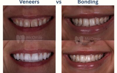 Veneers vs. Bonding: Which Cosmetic Fix Is Right for Your Chattanooga Smile?