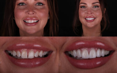 How to Close a Gap in Your Teeth: Veneers, Bonding, or Invisalign in Chattanooga