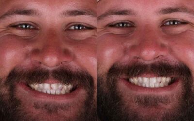 When a Cracked Tooth Needs a Crown Instead of a Filling