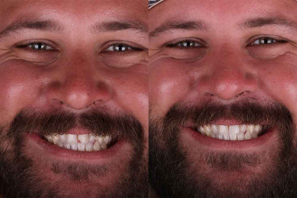 chipped-tooth-crown-fix Dentist placing a dental crown on a cracked tooth to restore a deep chip beyond a simple filling repair