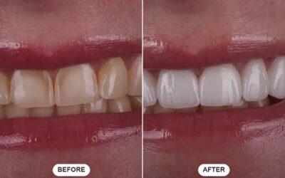 How Long Do Porcelain Veneers Last, and What Shortens Their Lifespan?