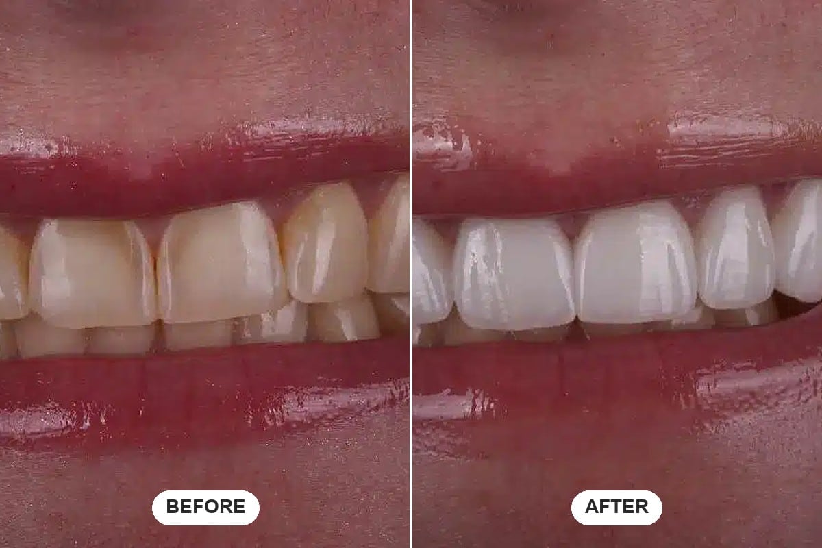 Before and after side-by-side smile comparison showing porcelain veneers results and how long they last